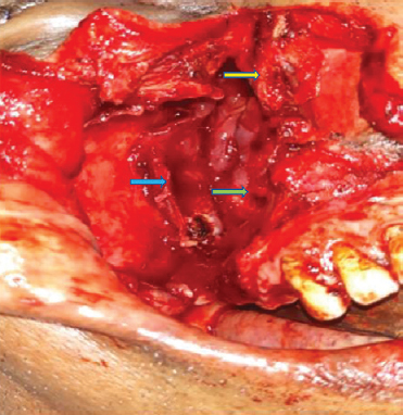 Post-excision cavity with yellow arrow shows superior turbinate. Green arrow shows the nasopharynx. Blue arrow shows the wall of pterygopalatine fossa.